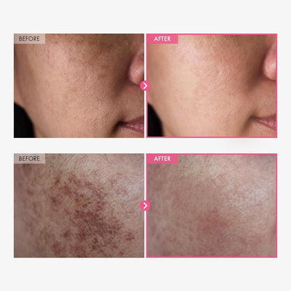 Erase Dark Spots. Unlock Radiant Skin