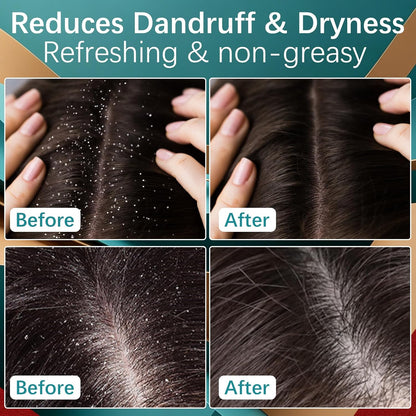 5% Minoxidil Scalp Treatment - Cream Formula For Fuller-Looking Hair