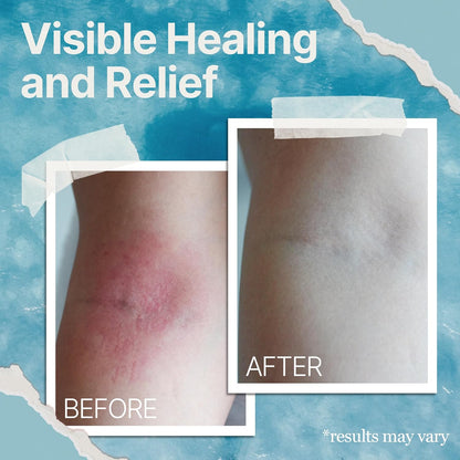 STOP THE ITCH. CALM YOUR SKIN FAST.