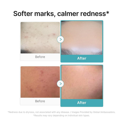 Azelaic Acid Serum - 16% Clarifying Formula For Balanced, Smoother-Looking Skin