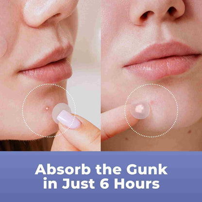Shrink Stubborn Blemishes Overnight with Salicylic Hydrocolloid Patche