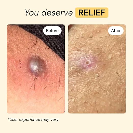 All-Purpose Skin Care Ointment: Fast-Acting Relief for Painful Bumps, Boils, and Sudden Skin Flares