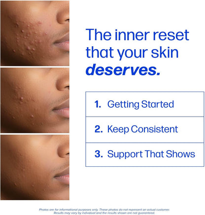 3-in-1 Triple Action Acne Complex: Clear Your Skin from Within
